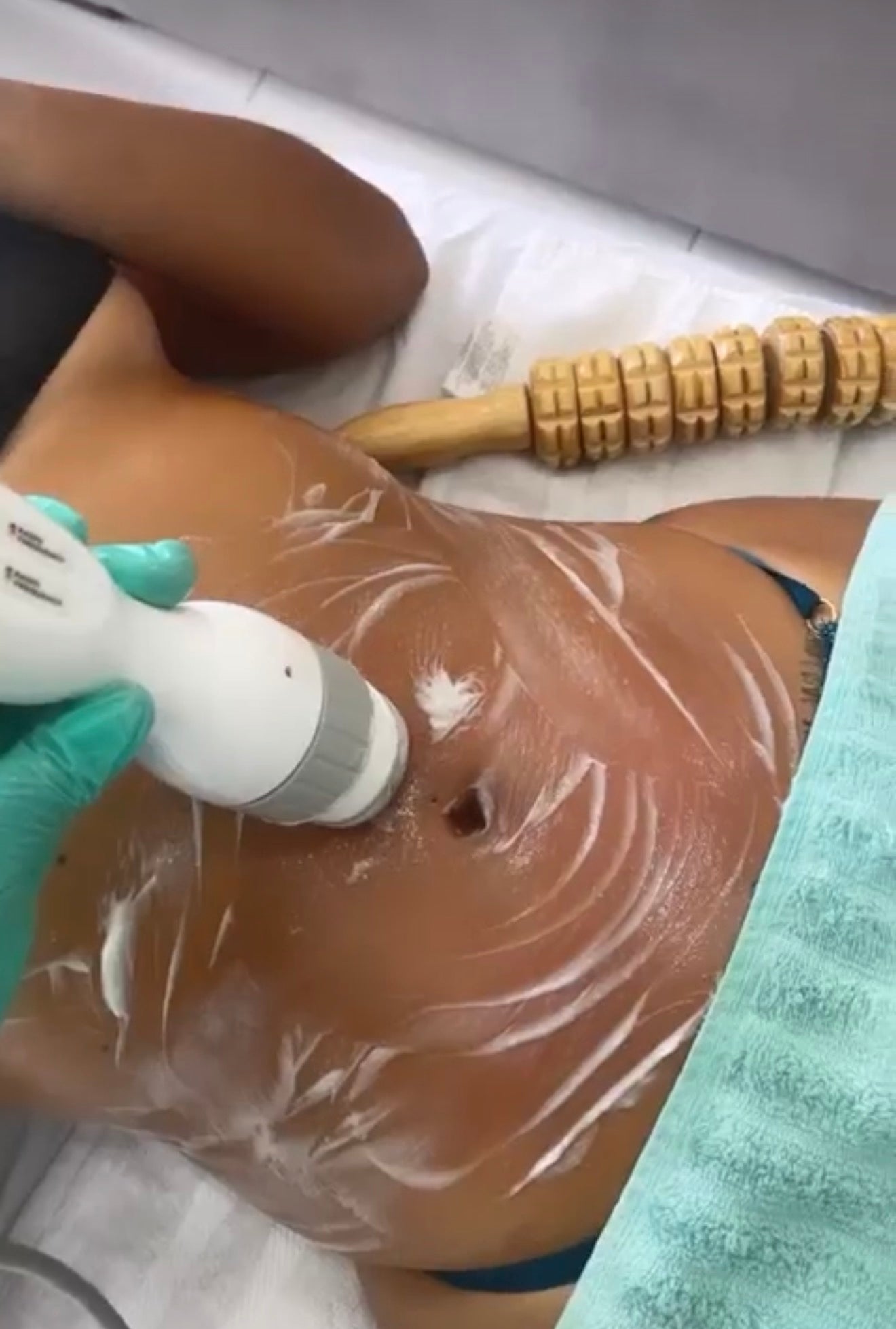 Skin Tightening (Arms + Waist) – (45 Minutes)