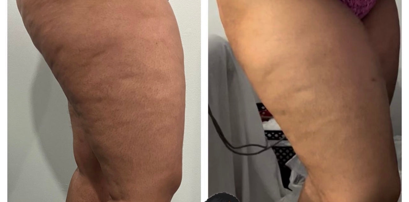Top Tier Cellulite Treatment (45 Minutes)